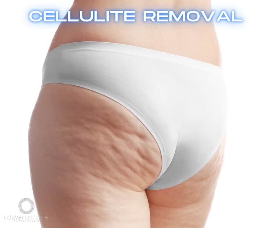 Cellulite Removal